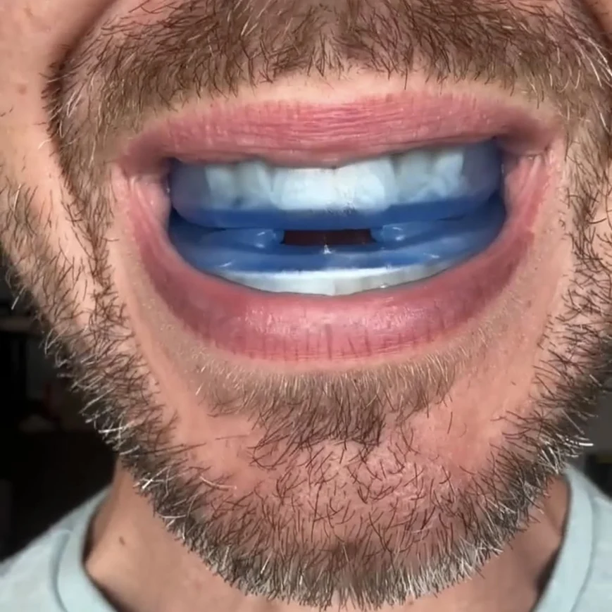 Honex Anti-Snoring Mouthpiece